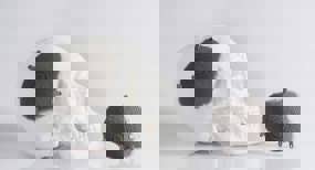 implant crânien imprimé en 3D par Protolabs